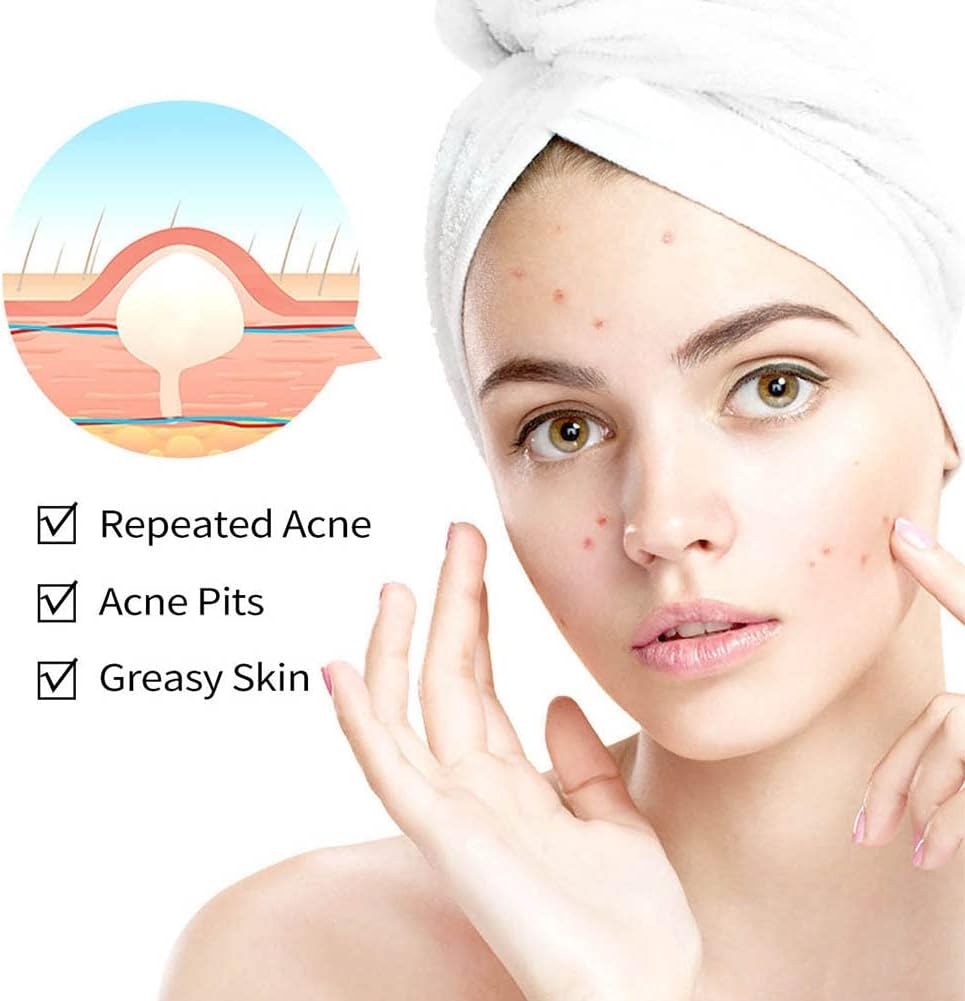 Onkessy Repair Acne Cream, Acne Removal Cream, Pimple Treatment Cream Hydrating Control Oil Quickly Remove Pimples, Get Rid of acne & Pimples Suitable for Men and Women
