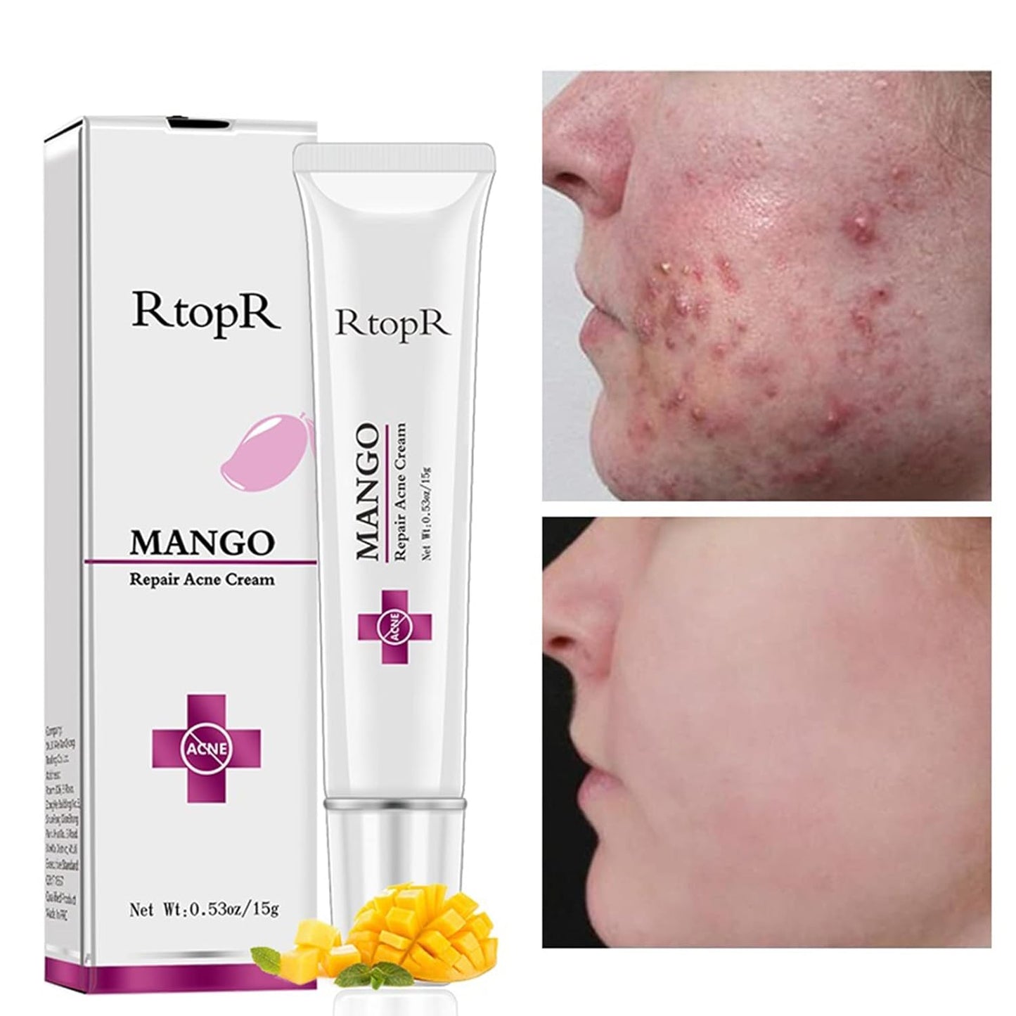 Easilydays Mango Repair Acne Cream, Face Pimple Removal Cream Acne Scar Treatment, Moisturize Skin, Fade Pockmarks Gently and Shrink Pores, for Acne Scar Removal, Spots, Balanced Water and Oil