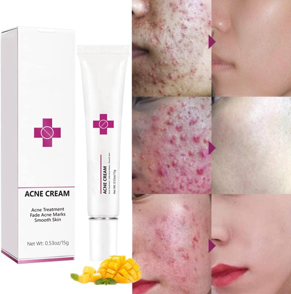 Onkessy Repair Acne Cream, Acne Removal Cream, Pimple Treatment Cream Hydrating Control Oil Quickly Remove Pimples, Get Rid of acne & Pimples Suitable for Men and Women