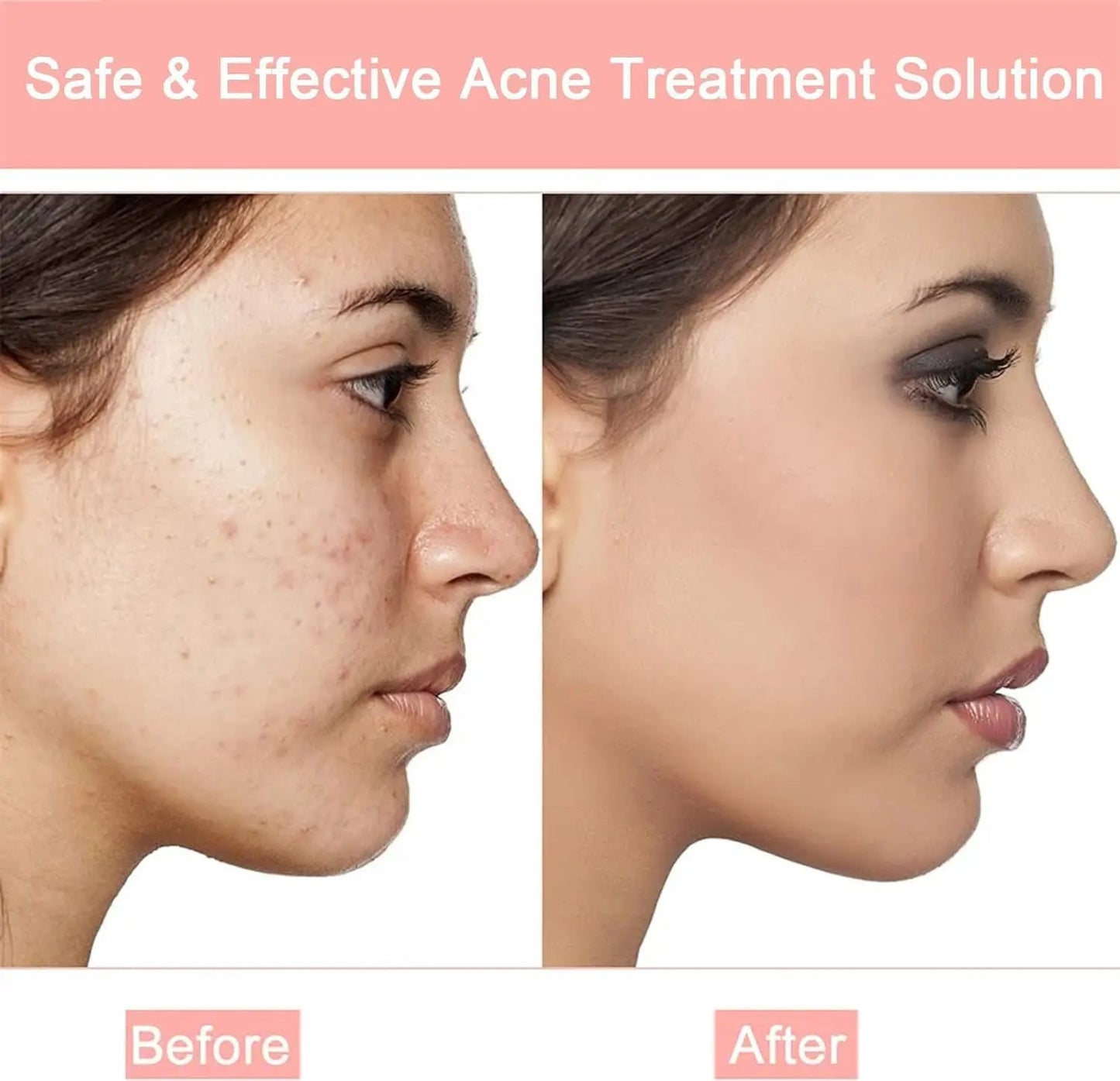 Rpanle Acne Patches, 180pcs Invisible Hydrocolloid Absorbing Pimple Patches, Acne Stickers Two Sizes, Blends in with Skin Rpanle