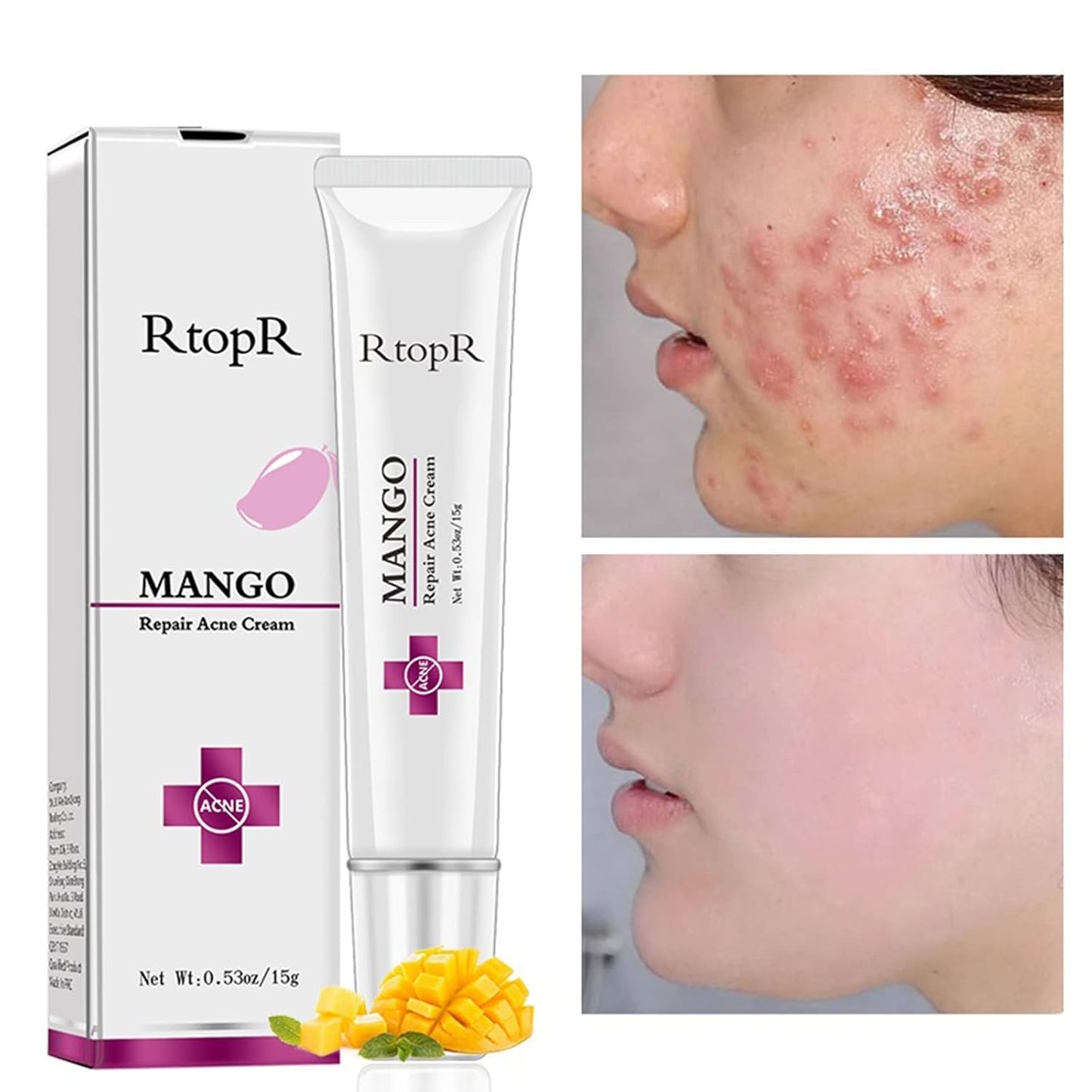 Easilydays Mango Repair Acne Cream, Face Pimple Removal Cream Acne Scar Treatment, Moisturize Skin, Fade Pockmarks Gently and Shrink Pores, for Acne Scar Removal, Spots, Balanced Water and Oil