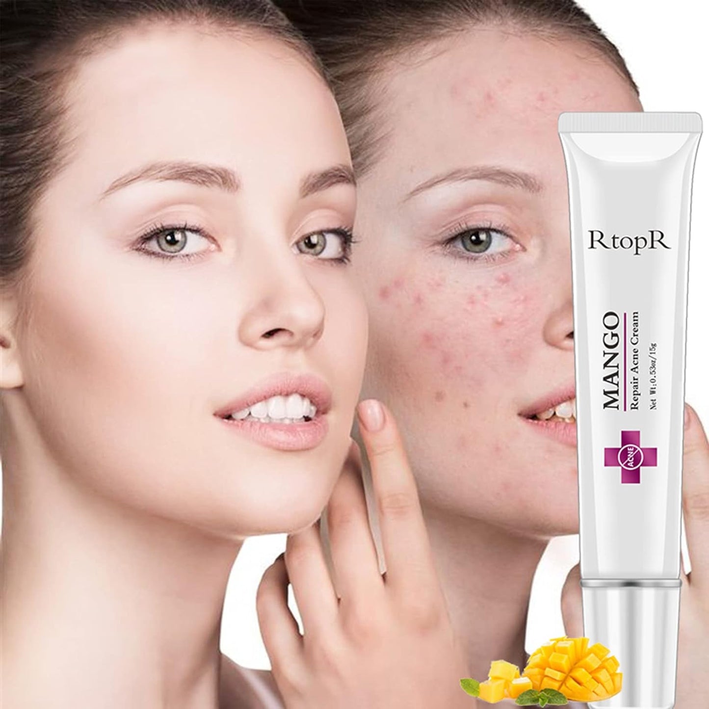 Easilydays Mango Repair Acne Cream, Face Pimple Removal Cream Acne Scar Treatment, Moisturize Skin, Fade Pockmarks Gently and Shrink Pores, for Acne Scar Removal, Spots, Balanced Water and Oil