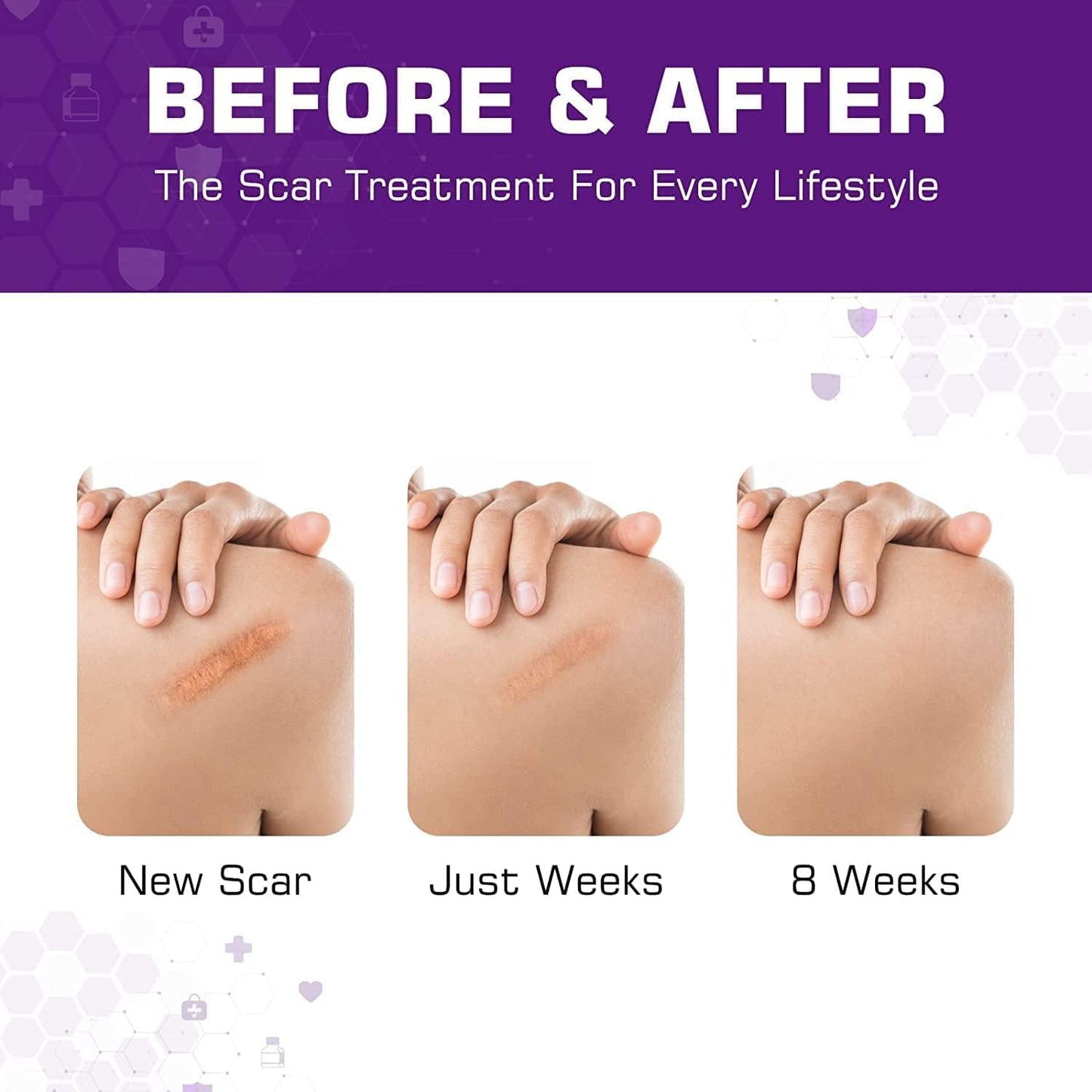 Kelinul Advanced Scar Cream - Silicone Scar Gel for Scars - Medical Grade Silicone Scar Removal Crean for C-Section & Keloid Surgery, Burn, Acne, Tummy Tuck - 1.7 oz