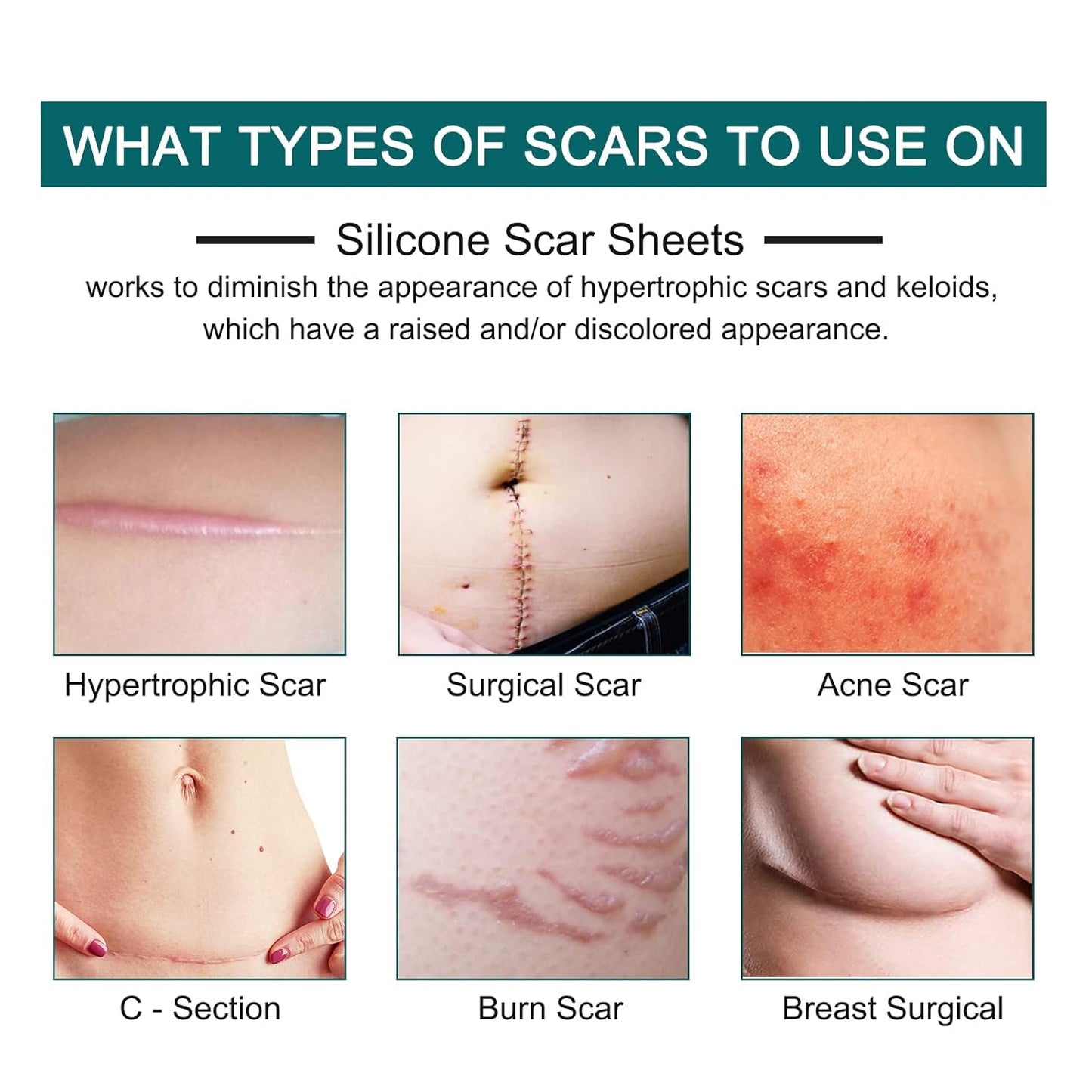 Silicone Scar Sheets (1.6” x 120” Roll-3M), Silicone Scar Tape Roll, Scar Silicone Strips, Reusable, Professional Scar Removal Sheets for C-Section, Surgery, Burn, Keloid, Acne et
