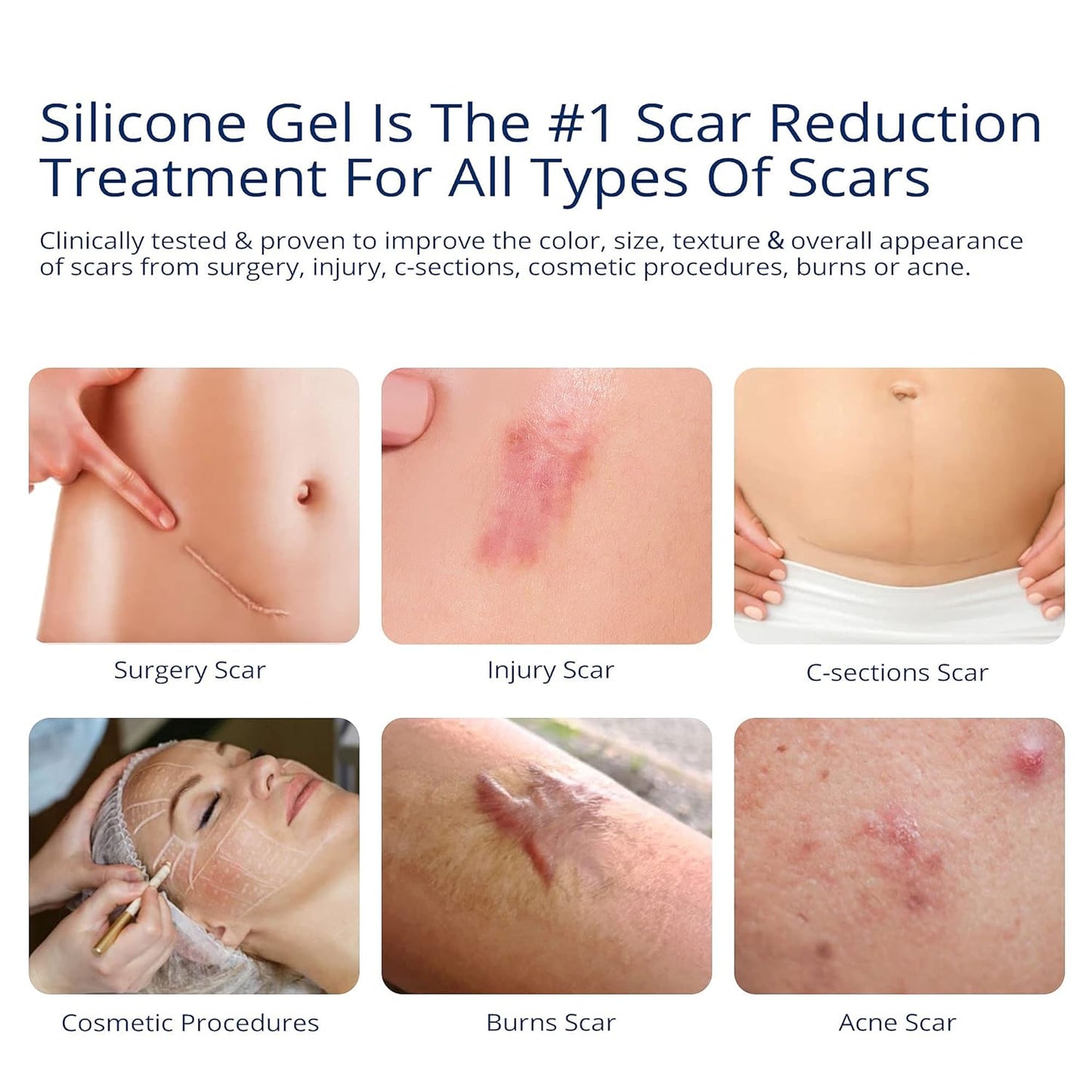 Scar Cream Gel, Silicone Scar Gel for C-Section, Stretch Marks, Acne, Surgery, Surgical Effective Treatment, Old and New Scars Management - 30g