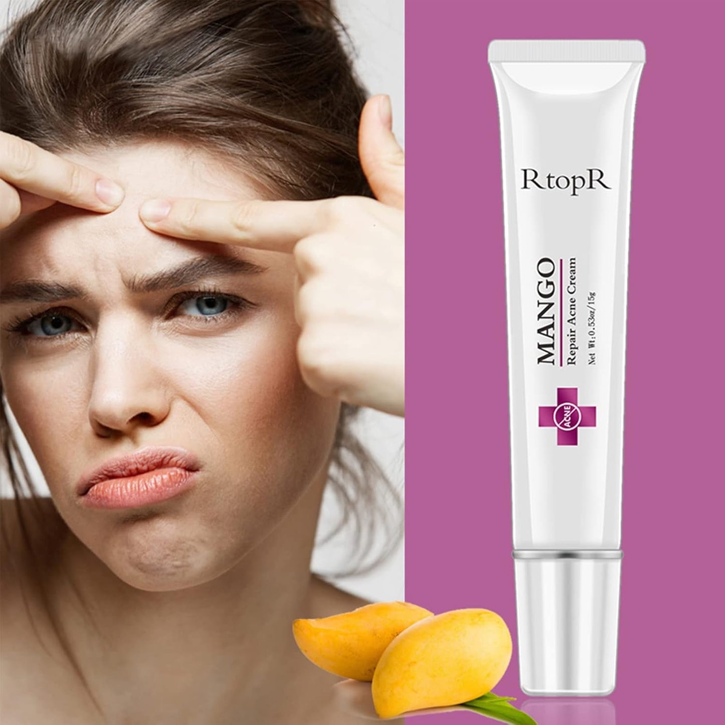 Easilydays Mango Repair Acne Cream, Face Pimple Removal Cream Acne Scar Treatment, Moisturize Skin, Fade Pockmarks Gently and Shrink Pores, for Acne Scar Removal, Spots, Balanced Water and Oil