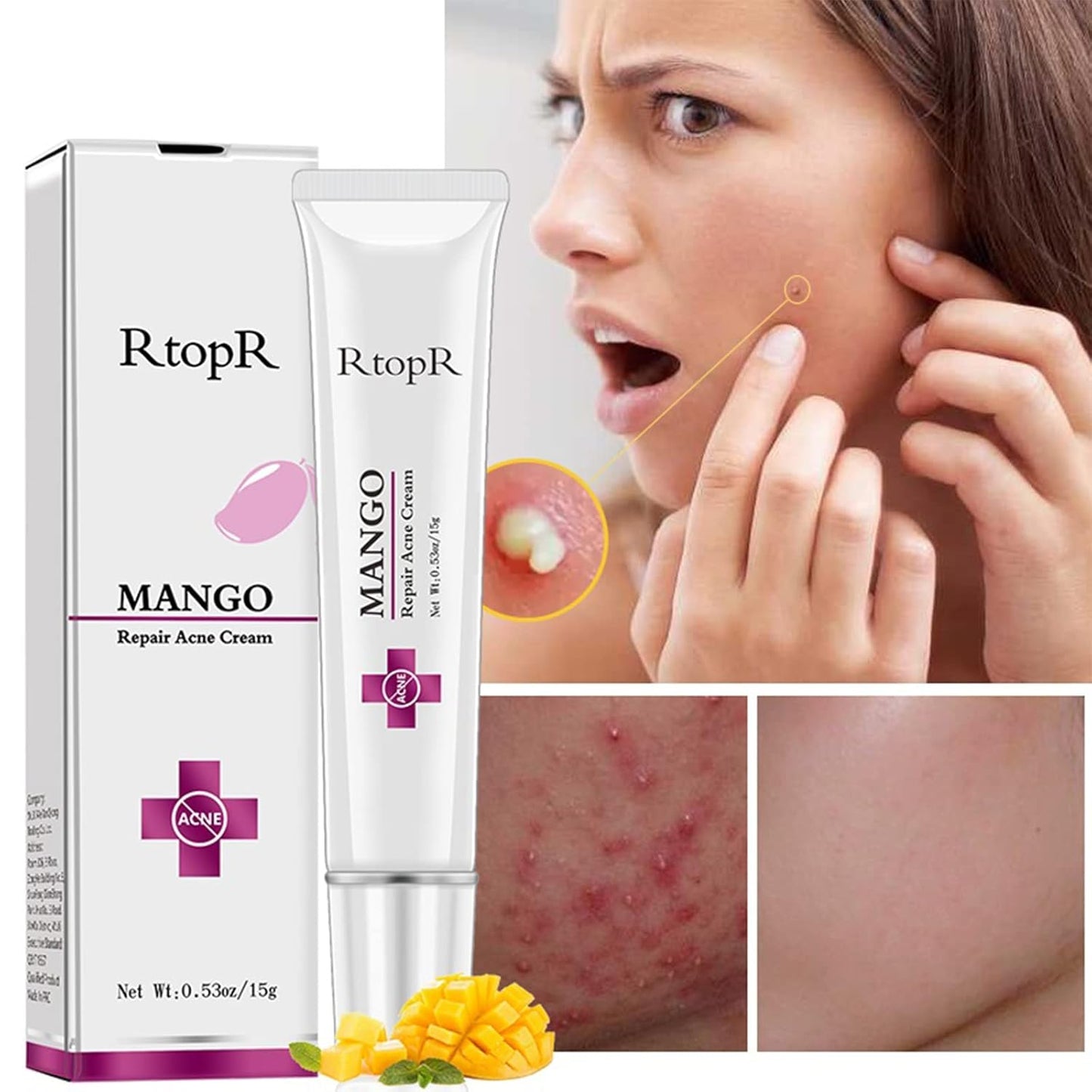 Easilydays Mango Repair Acne Cream, Face Pimple Removal Cream Acne Scar Treatment, Moisturize Skin, Fade Pockmarks Gently and Shrink Pores, for Acne Scar Removal, Spots, Balanced Water and Oil