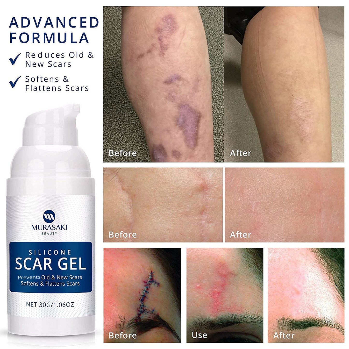 Scar Cream Gel, Silicone Scar Gel for C-Section, Stretch Marks, Acne, Surgery, Surgical Effective Treatment, Old and New Scars Management - 30g