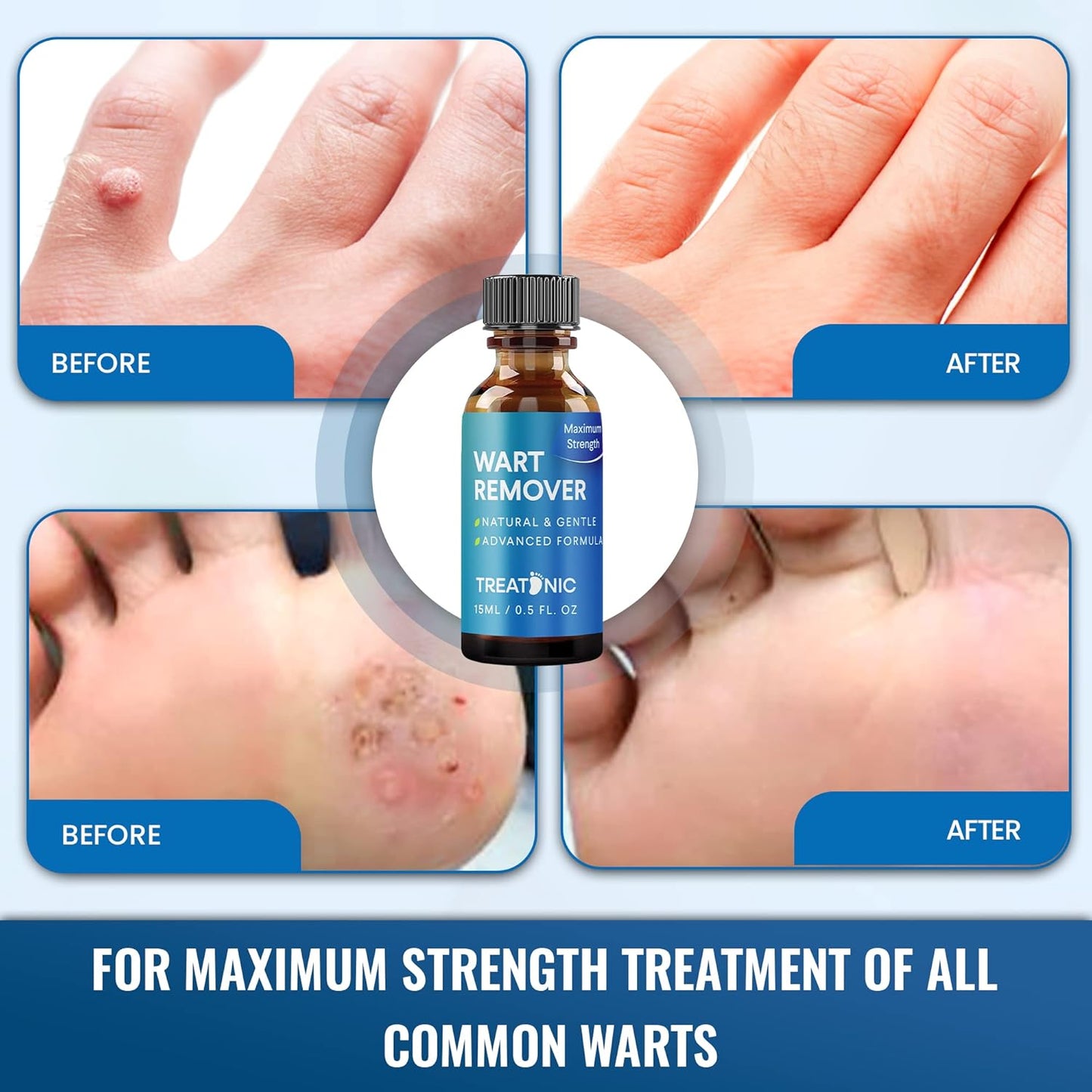 Treatonic Wart Remover, Wart Remover Freeze Off, Wart Removal, Fast Acting Gel Wart Remover, Plantar Wart Remover for Feet, Suitable for All Skin Types