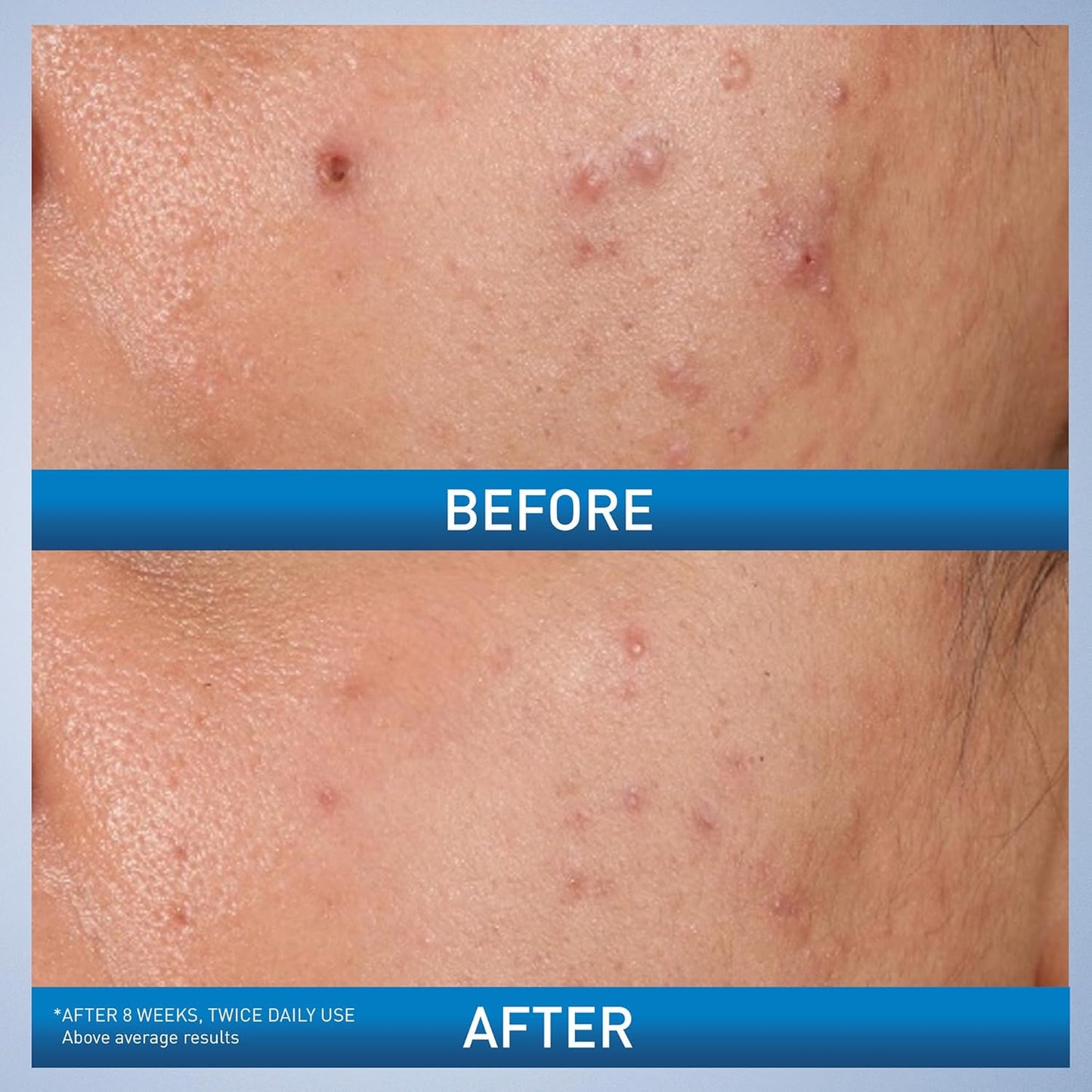 CeraVe Salicylic Acid Acne Control Gel Treatment, Acne Treatment for Face, 1.35 fl oz.