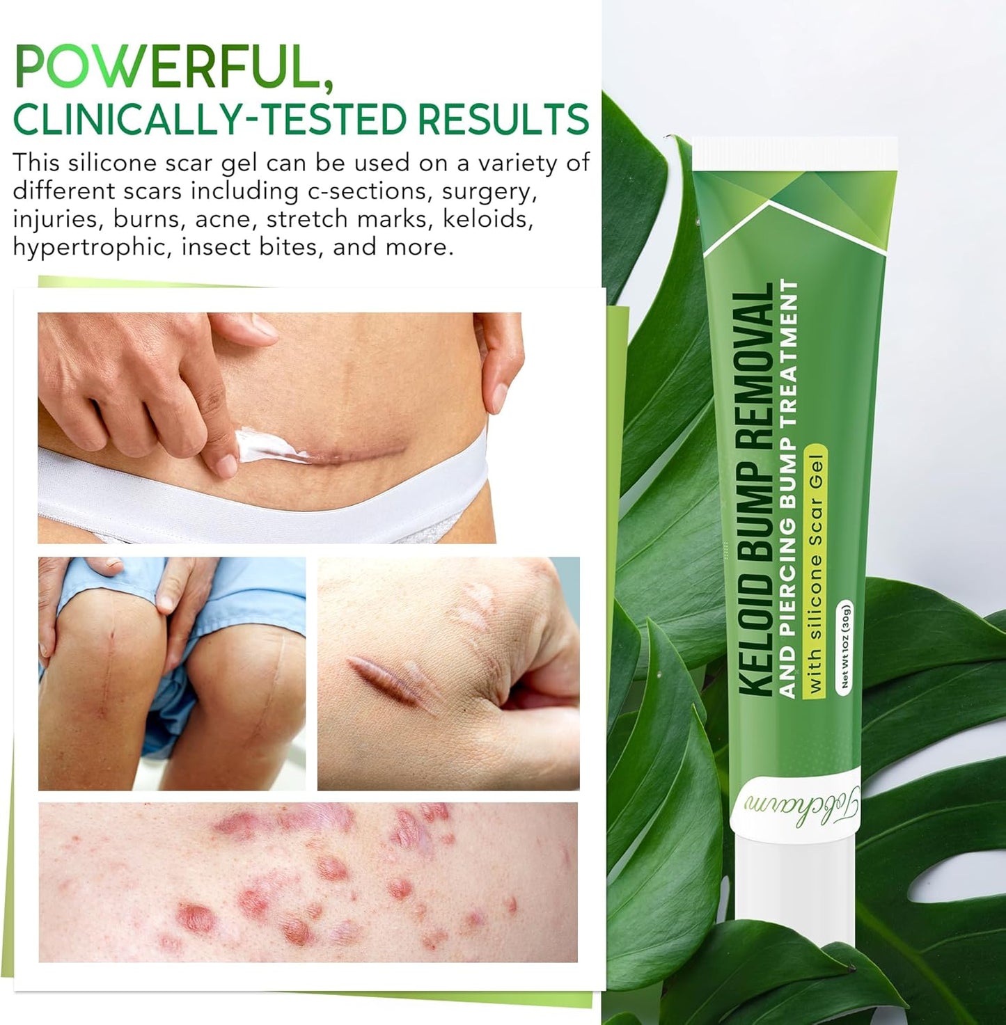 Tobcharm Keloid Scar Removal, Keloid Bump Removal for Piercings like Nose, Ear Piercings Keloid, also works for Stretch Marks, Surgical Scars, Great Piercing Bump Treatment with 30g Silicone Gel
