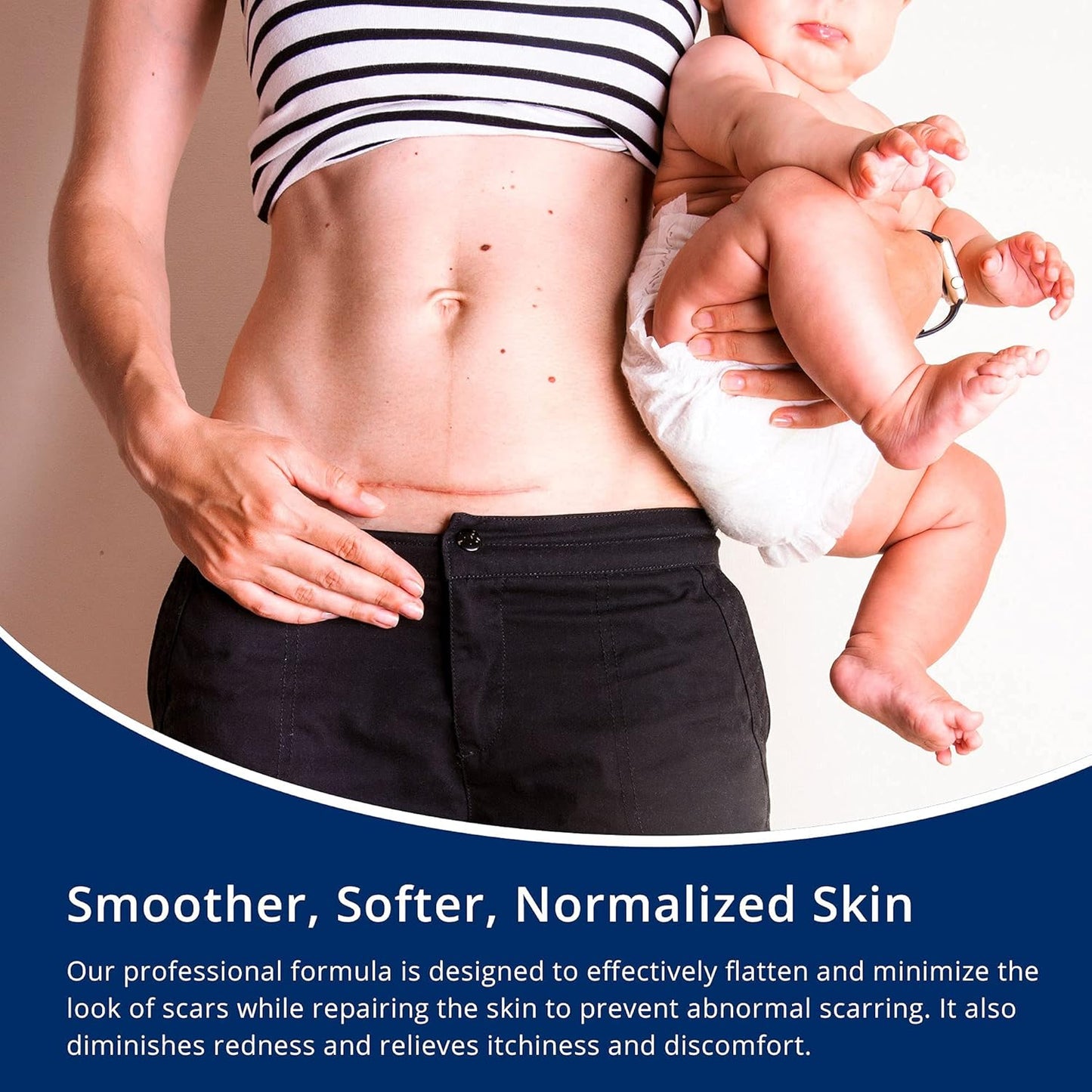 Scar Cream Gel, Silicone Scar Gel for C-Section, Stretch Marks, Acne, Surgery, Surgical Effective Treatment, Old and New Scars Management - 30g