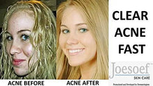 JOESOEF SKIN CARE Sulfur Soap for Acne Pharmaceutical Grade Dermatologists Approved for Acne Rosacea 100G JOESOEF SKIN CARE