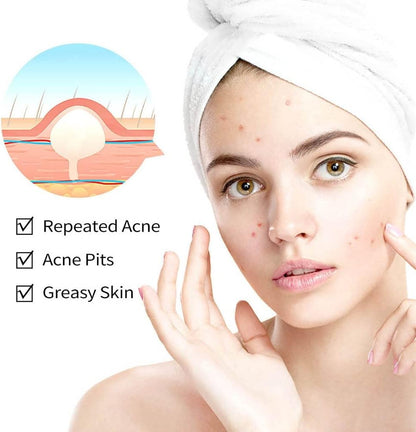 Onkessy Repair Acne Cream, Acne Removal Cream, Pimple Treatment Cream Hydrating Control Oil Quickly Remove Pimples, Get Rid of acne & Pimples Suitable for Men and Women