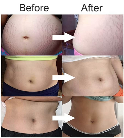 Pregnancy Stretch Mark Prevention Cream - Moisturizing Belly Stretch Mark Cream Remover Rich in High-Potency Cocoa, Aloe, Shea Butter - Hypoallergenic Nourishing Pregnancy Must Have Skin Care - 4oz