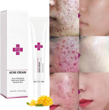 Onkessy Repair Acne Cream, Acne Removal Cream, Pimple Treatment Cream Hydrating Control Oil Quickly Remove Pimples, Get Rid of acne & Pimples Suitable for Men and Women Onkessy