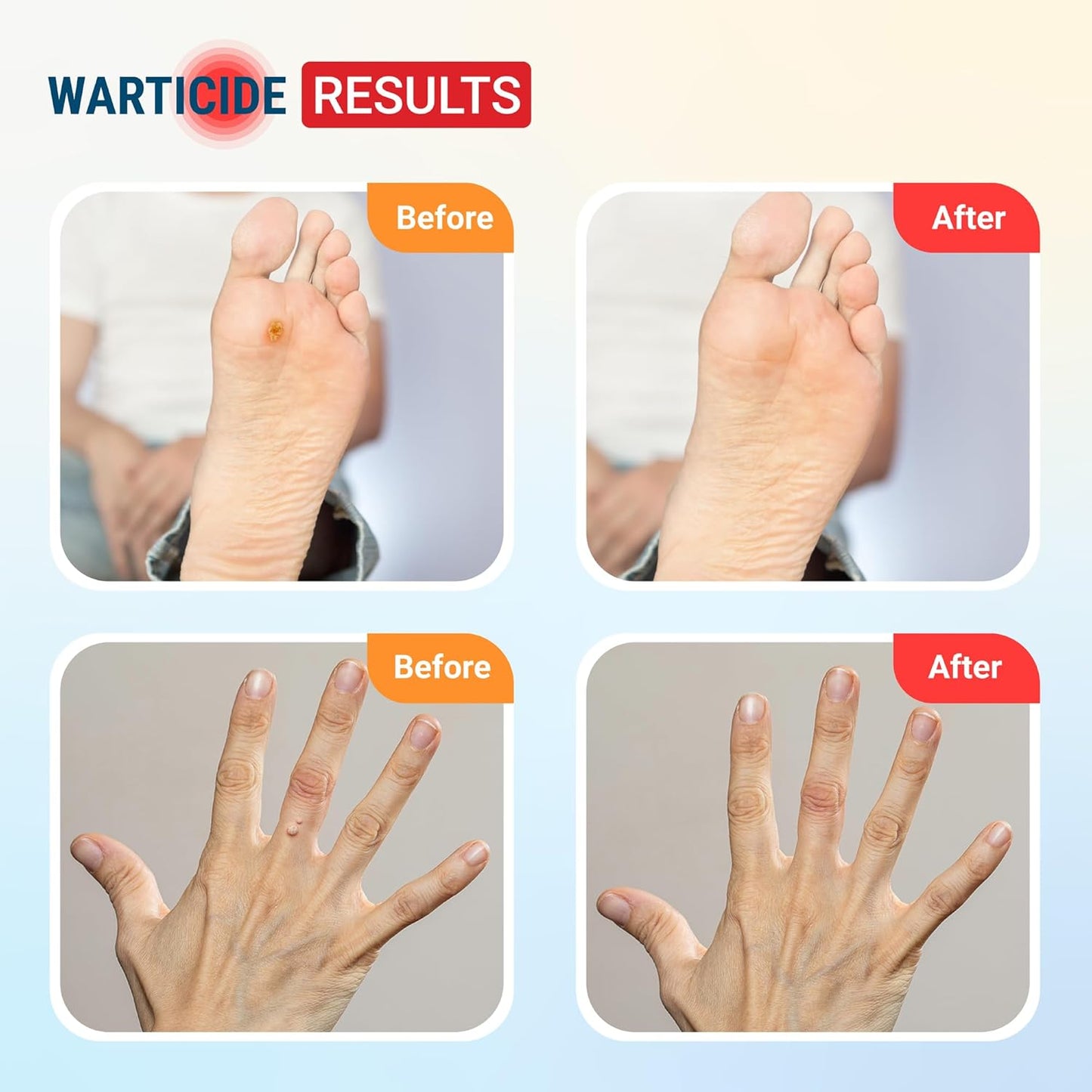 Warticide Fast-Acting Wart Remover - Plantar and Genital Wart Treatment, Attacks Warts On Contact, Easy Application (1 Fluid Ounce)