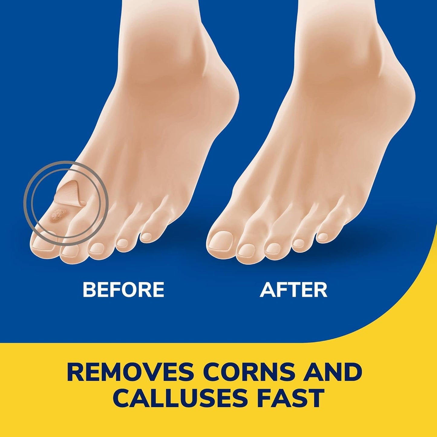 Dr. Scholl's Liquid Corn and Callus Remover to  Remove Corns and Calluses Fast, 3oz