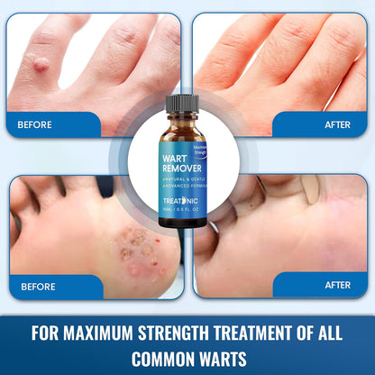 Treatonic Wart Remover, Wart Remover Freeze Off, Wart Removal, Fast Acting Gel Wart Remover, Plantar Wart Remover for Feet, Suitable for All Skin Types