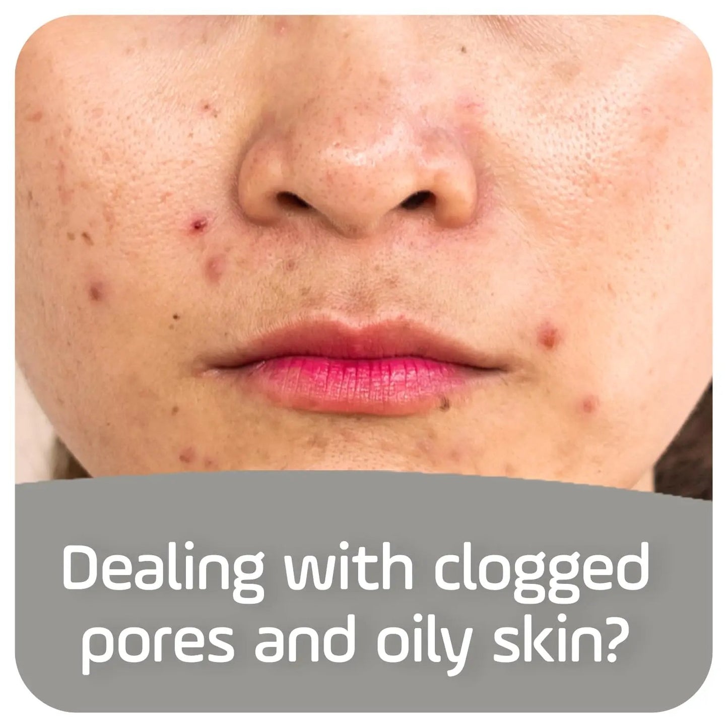 Asepxia Deep Cleansing Acne Treatment Bar Soap with Baking Soda and 2% Salicylic Acid, 4 Ounce Asepxia