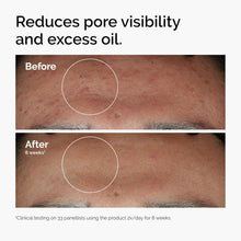 The Ordinary Niacinamide 10% + Zinc 1%, Smoothing Serum for Blemish-Prone Skin The ordinary