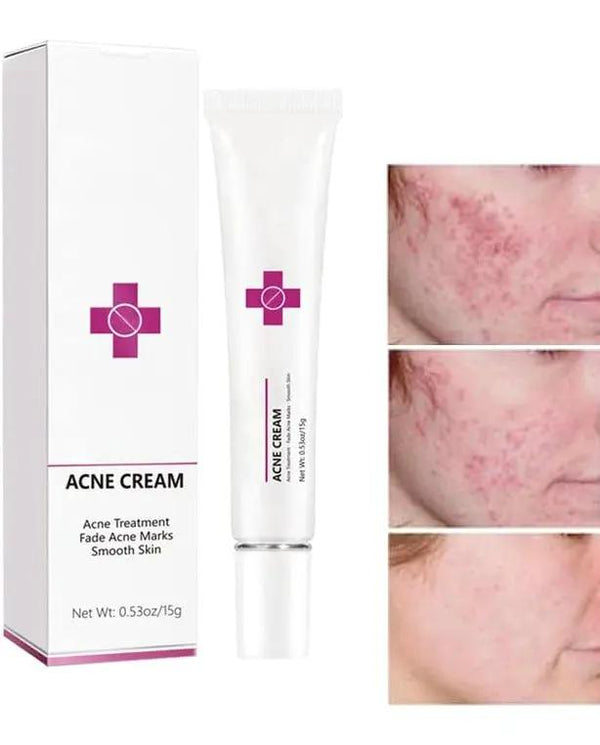 Onkessy Repair Acne Cream, Acne Removal Cream, Pimple Treatment Cream Hydrating Control Oil Quickly Remove Pimples, Get Rid of acne & Pimples Suitable for Men and Women
